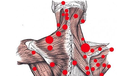 Points de déclenchement dans les muscles qui causent des maux de dos myofasciaux