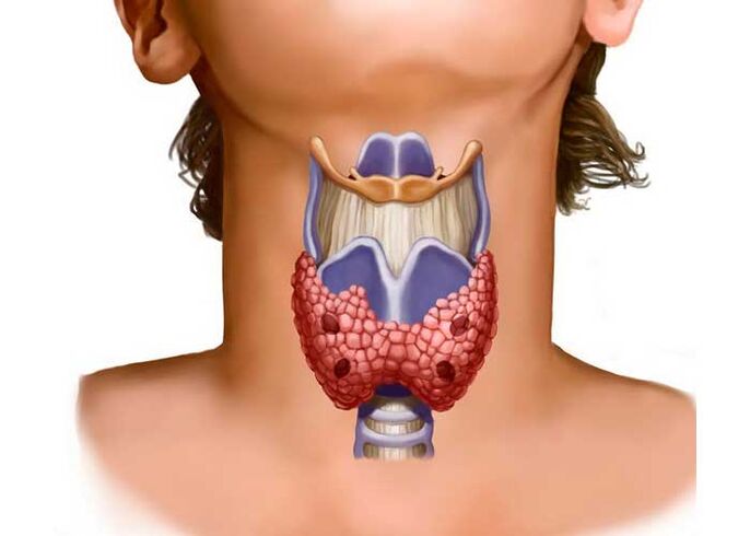 problèmes de thyroïde comme cause de douleurs au cou