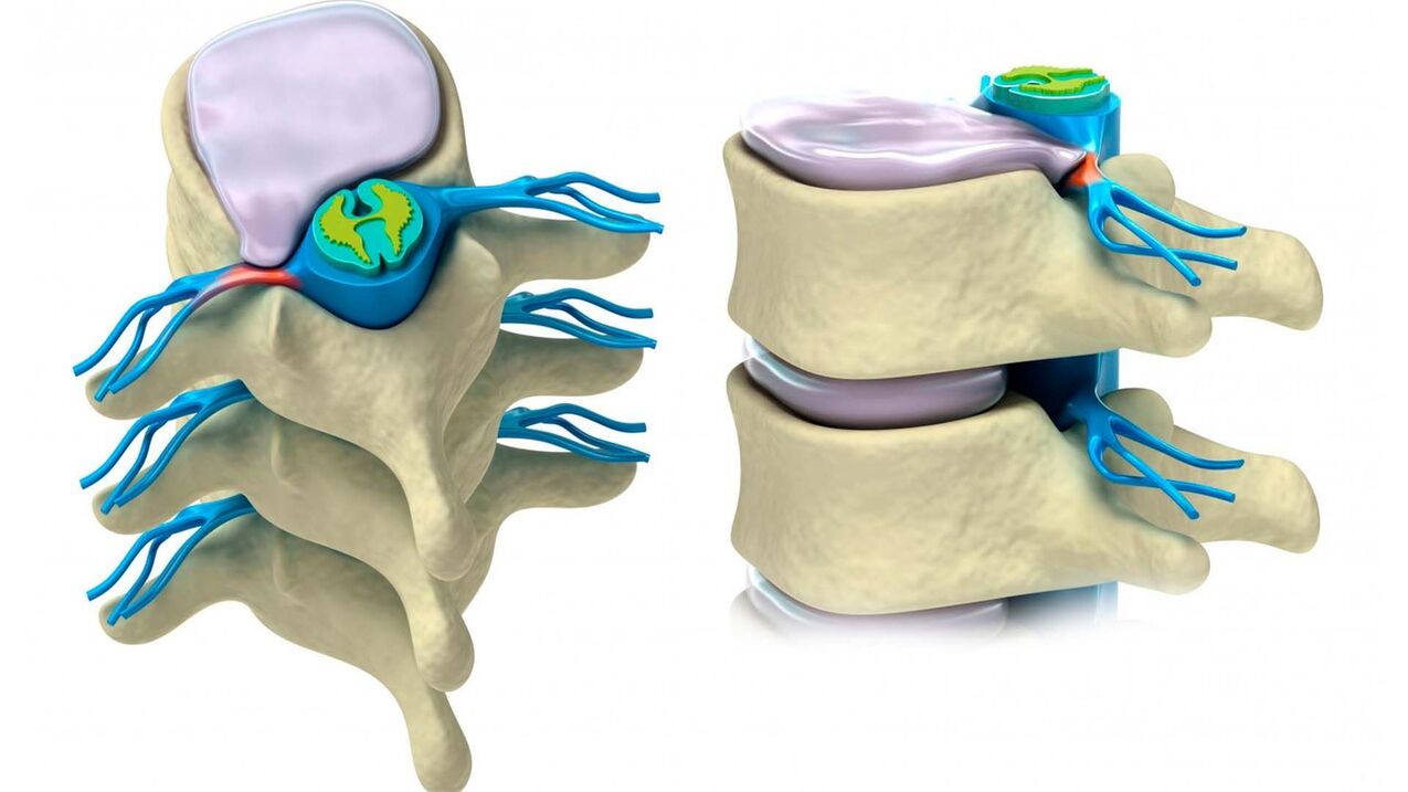 disque spinal endommagé