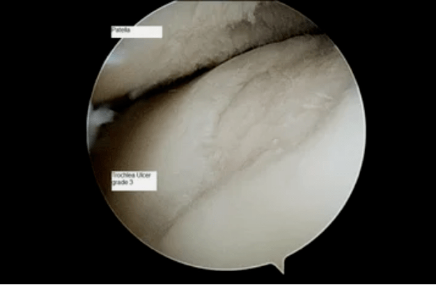 Vue astroscopique d'une articulation du genou atteinte d'arthrose du troisième degré.