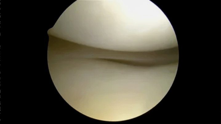 Vue astroscopique de surfaces complètement saines.